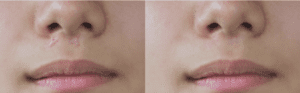 Before and after of laser scar revision treatment at Profile MD